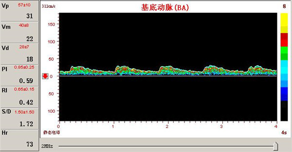 經(jīng)顱多普勒檢測椎基底動脈供血障礙的表現(xiàn)